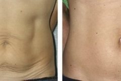 thermage-tummy-500x186