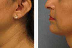 Thermi Treatments