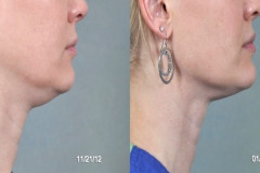 Chin-Thermilift