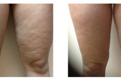 Legs-Thermilift