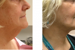 Therlift-before-after