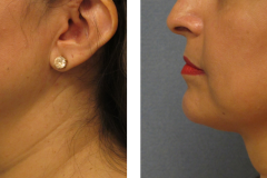 Thermi-neck