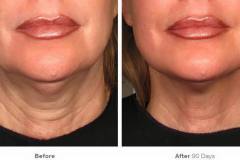 ThermiLIft-before-and-after