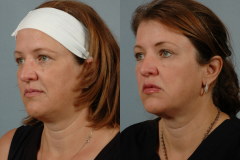 Thermilift-and-Thermismooth-Combo