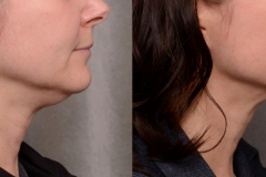 neck-tightening
