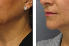 thermi-neck-bands-before-after