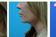 thermilift-progression