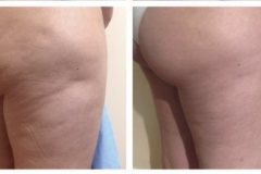 thermirf-thigh-cellulite-reduction