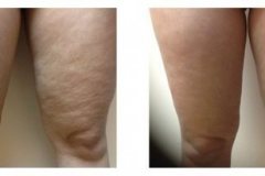 thermirf-tight-fat-reduction