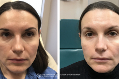 pdo-thread-lifts-the-dermatology-laser-vein-center-cincinnati-ohio-before-after-1