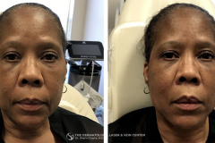 pdo-thread-lifts-the-dermatology-laser-vein-center-cincinnati-ohio-before-after-2