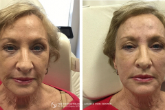 pdo-thread-lifts-the-dermatology-laser-vein-center-cincinnati-ohio-before-after-3-1