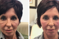 pdo-thread-lifts-the-dermatology-laser-vein-center-cincinnati-ohio-before-after-4-1