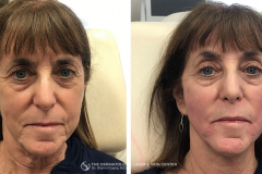 pdo-thread-lifts-the-dermatology-laser-vein-center-cincinnati-ohio-before-after-5-1