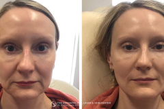 pdo-thread-lifts-the-dermatology-laser-vein-center-cincinnati-ohio-before-after-6-1