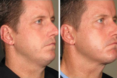 ulthera_after_before_10