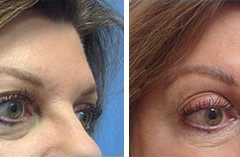 ulthera_after_before_11