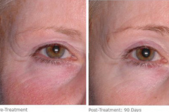 ulthera_after_before_4