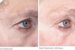 ulthera_after_before_5