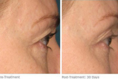 ulthera_after_before_6