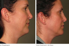 ulthera_after_before_7