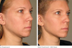 ulthera_after_before_8