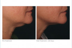 ultherapy_lower_face_2-1-1