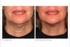 ultherapy_lower_face_2-7