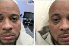 Undereye Rejuvenation