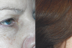 Upper Eyelid Surgery