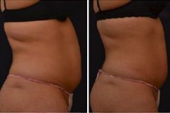 vanquish-fat-removal-before-after