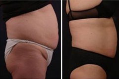 vanquish-fat-removal-before-and-after-procedure