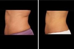 vanquish-fat-removal-before-and-after-results