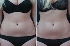 vanquish-fat-removal-before-and-after