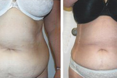 Vaser Liposuction