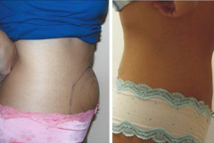 vaser-liposuction-1