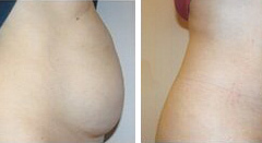 vaser-liposuction-3