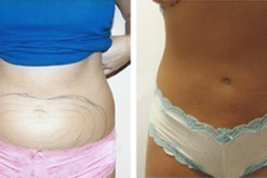 vaser-liposuction-4