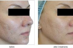 VVI_BeforeAfter_025