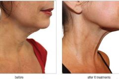 VVI_BeforeAfter_036