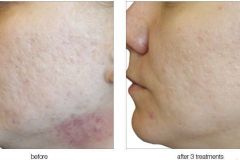 VVI_BeforeAfter_09