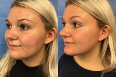 before-after-3