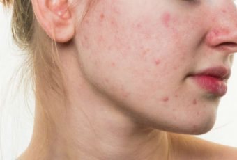 Common Causes of Acne