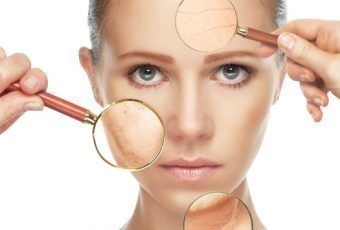 Microneedling for Hyperpigmentation Treatment