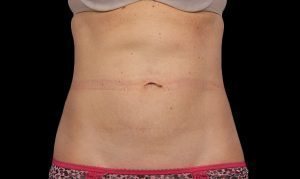 Coolsculpting