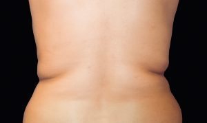 Coolsculpting