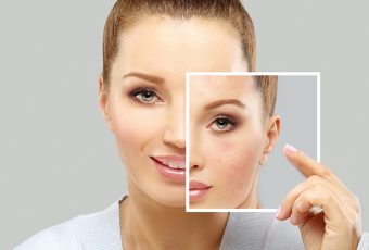Reasons Why Early Acne Care Is Important