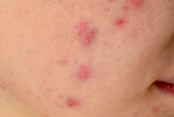 Reasons to Consider Acne Treatment