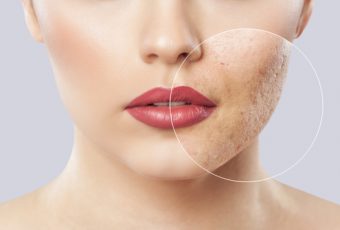 Take the Next Step with Acne Scar Removal