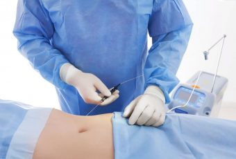 Is Smart Lipo the Same As Laser Lipo?